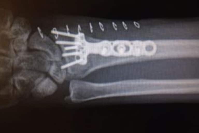 I learned first-hand, or wrist in this case